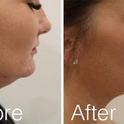 10.+Kybella-Before-After-Reduce-Double-Chin