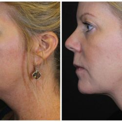 11.+Kybella-before-and-after-2-treatments