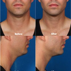 12.+Kybella+Treatment