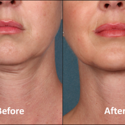 2.+Kybella+Treatment