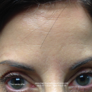 2.+Two+Weeks+After+18+units+of+Botox+Treatment