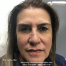 2.+Two+weeks+after+Botox+&+Cheek+Fillers