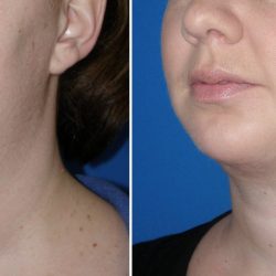 3.+Kybella+Treatment