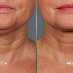 4.+Kybella+Treatment