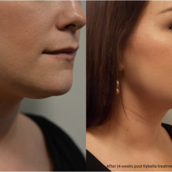 5.+Kybella+Treatment