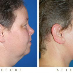 6.+Kybella+Treatment