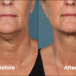 7.+Kybella+Treatment