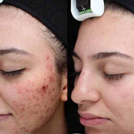 Chemical+Peel+BA+1