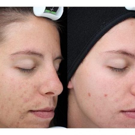 Chemical+Peel+BA+2