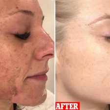 Dermaplaning+Update+3