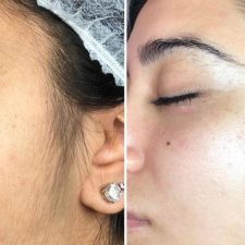 Dermaplaning+Update+4