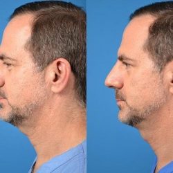 Kybella+man+update+2