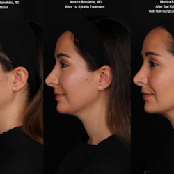 Kybella+woman+update+2