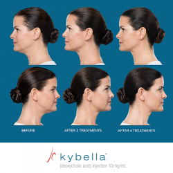 Kybella+woman+update+4